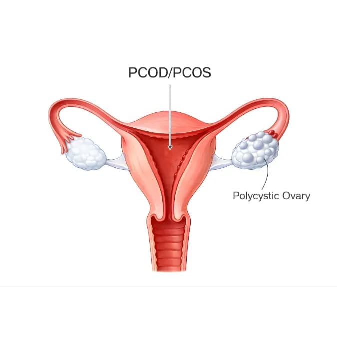 PCOD/PCOS treatment in Jaipur — Dr. Vibha Chaturvedi Sharma