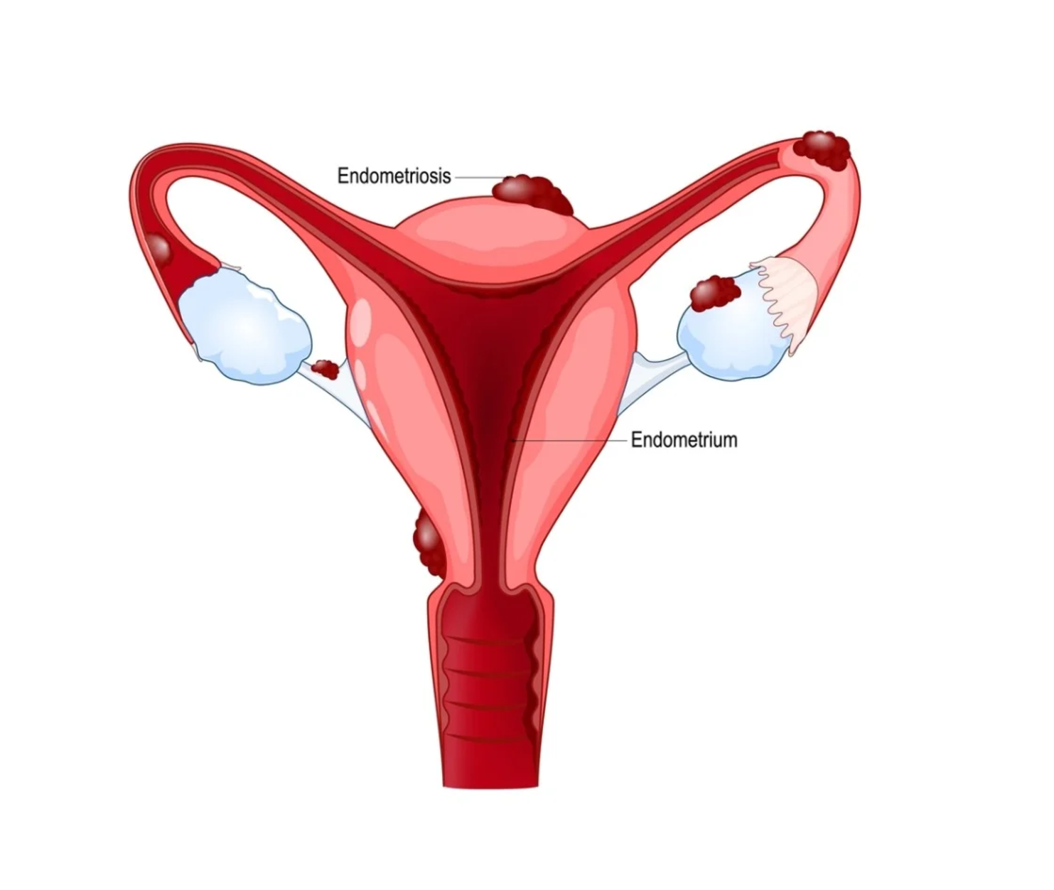 Endometriosis in Jaipur: Symptoms, Diagnosis, and Treatment Explained